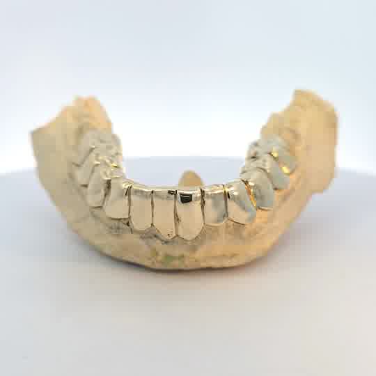 Custom Gold Teeth On Dental Model | My Jeweler